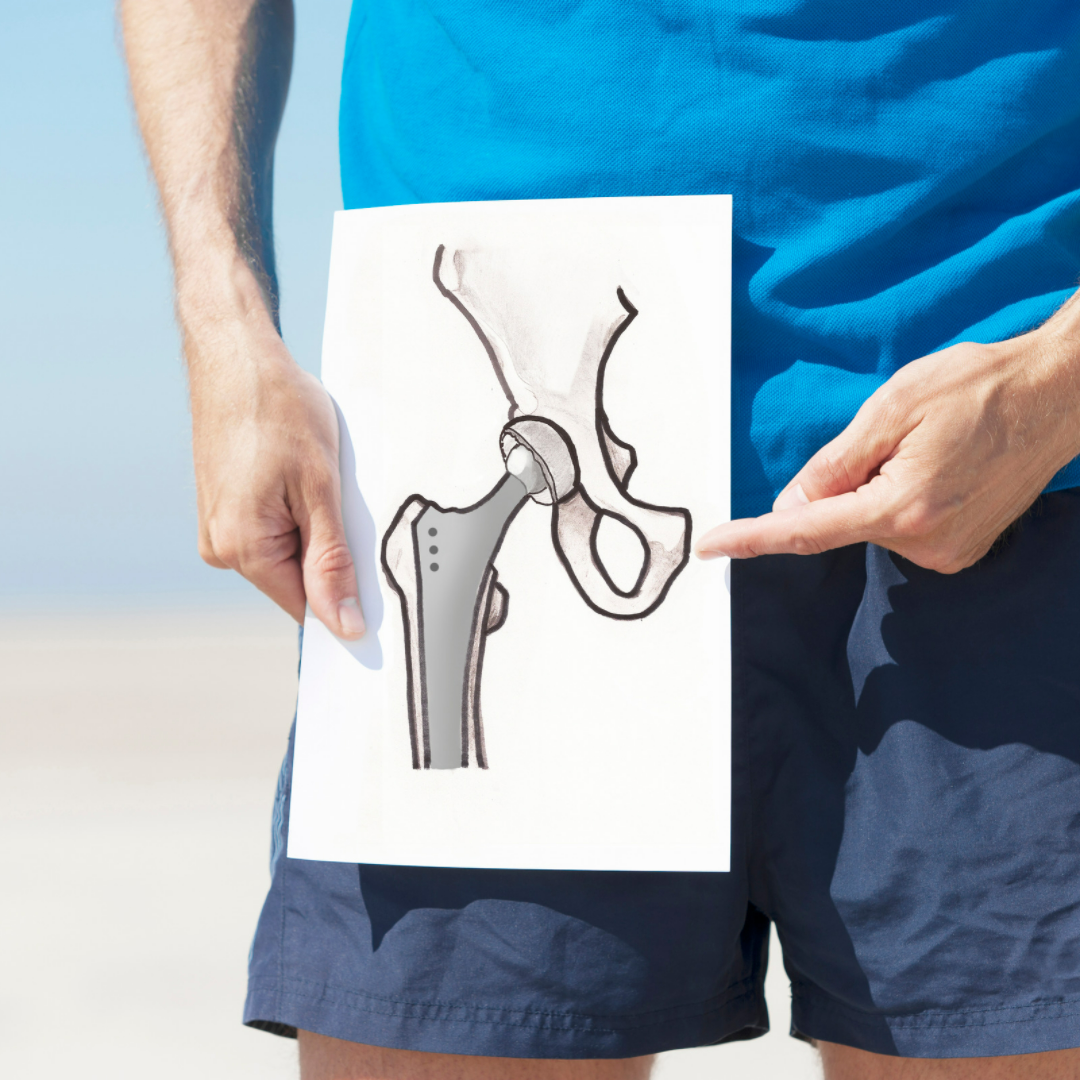 Best hip replacement surgery in India Best hip replacement surgery in India